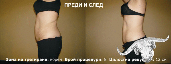 Израелско изобретение извайва тялото и връща самочувствието